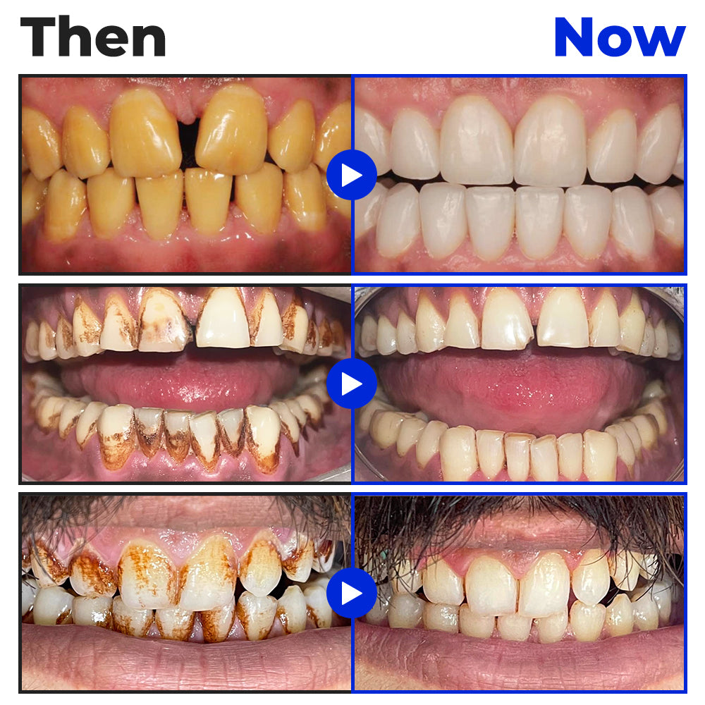 ❤️Furzero® Focussmile Bienengiftbehandlung Pulver zum Einnehmen 🦷 (🇩🇪 BZÄK Zugelassen)