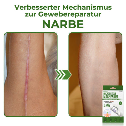 GFOUK® Magnesium MicroNeedle Schnell-Entfernungspflaster für Hautstellen