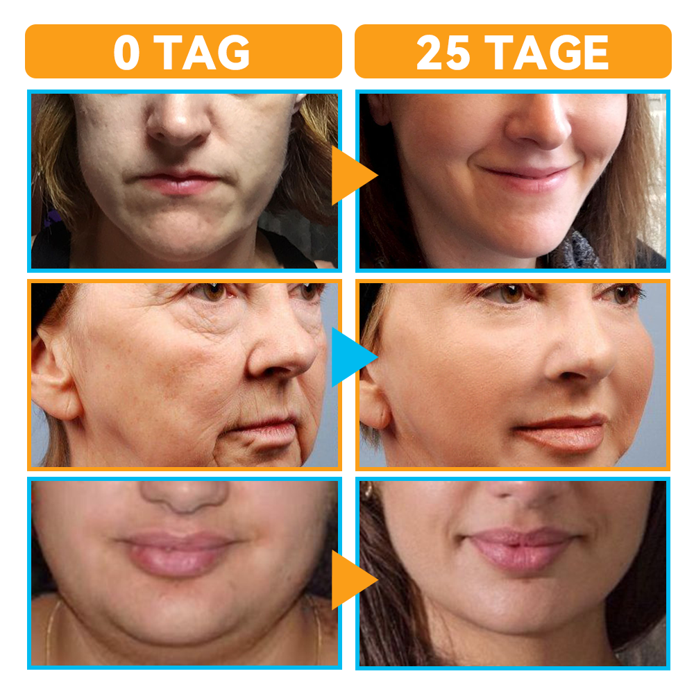 GFOUK™ Hochintensiver Fokussierter Ultraschall Facelifting Gerät