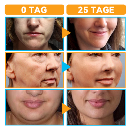 GFOUK™ Hochintensiver Fokussierter Ultraschall Facelifting Gerät