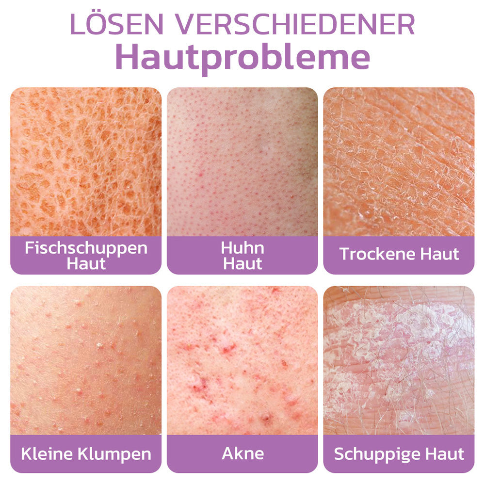 flysmus™ KP Keratose Gleichgewicht Radiergummi Körper Peeling