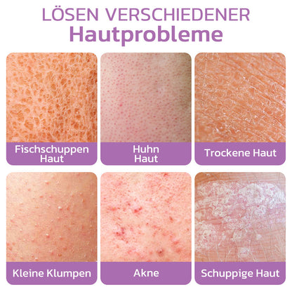 flysmus™ KP Keratose Gleichgewicht Radiergummi Körper Peeling