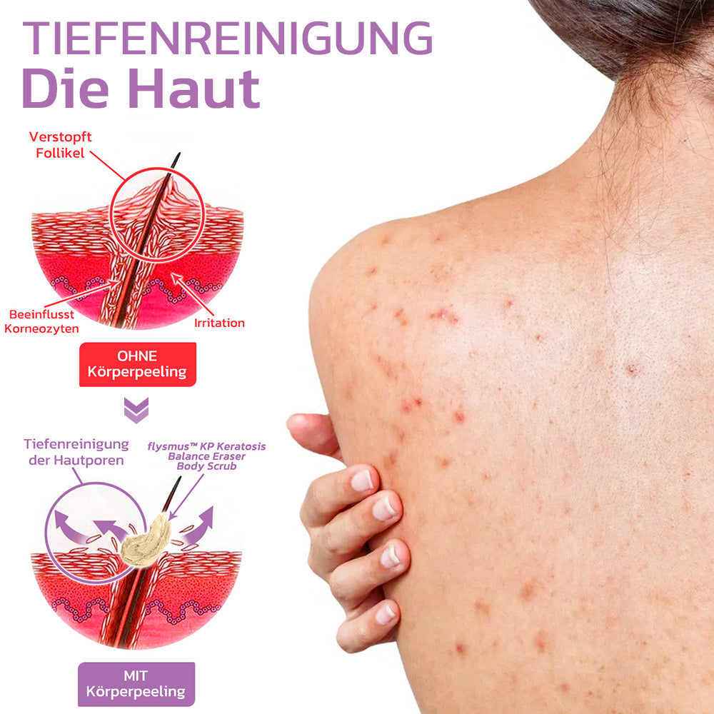 flysmus™ KP Keratose Gleichgewicht Radiergummi Körper Peeling